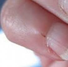 Burrs on the fingers: why they appear and how to remove them