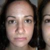 Шелушение кожи лица – эффективная омолаживающая процедура Глубокое шелушение